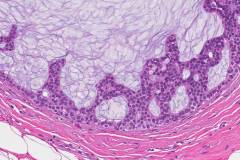 Ductal carcinoma in situ of the breast