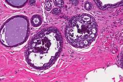 Ductal carcinoma in situ of the breast