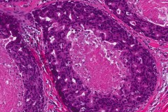 Ductal carcinoma in situ of the breast