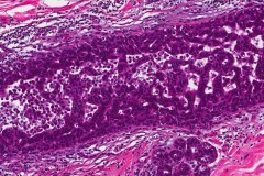 Ductal carcinoma in situ of the breast