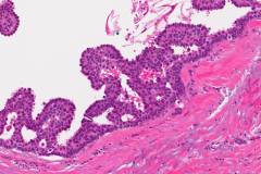 Ductal carcinoma in situ of the breast