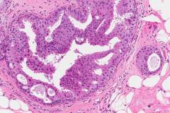 Ductal carcinoma in situ of the breast