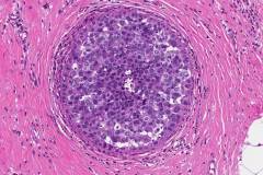 Ductal carcinoma in situ of the breast