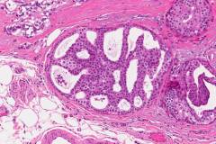 Ductal carcinoma in situ of the breast