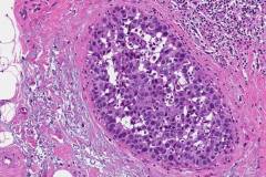 Ductal carcinoma in situ of the breast