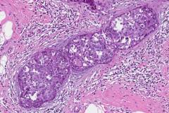 Ductal carcinoma in situ of the breast