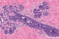 Ductal carcinoma in situ of the breast