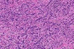 Dysgerminoma of the ovary