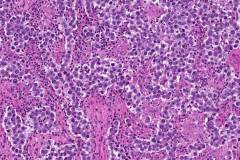 Dysgerminoma of the ovary