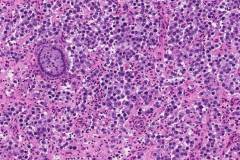 Dysgerminoma of the ovary