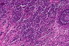 Dysgerminoma of the ovary