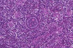 Dysgerminoma of the ovary