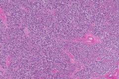 Dysgerminoma of the ovary