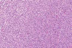 Ectomesenchymal chondromyxoid tumour