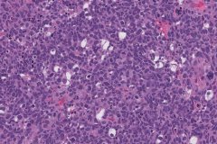 Anaplastic embryonal carcinoma of the testis