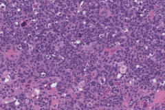 Anaplastic embryonal carcinoma of the testis