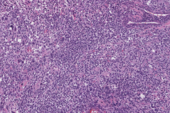 Anaplastic embryonal carcinoma of the testis