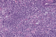 Anaplastic embryonal carcinoma of the testis