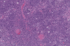 Anaplastic embryonal carcinoma of the testis