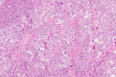 Embryonal carcinoma of the testis