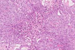 Embryonal carcinoma of the testis