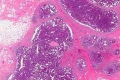 Encapsulated papillary carcinoma of the breast