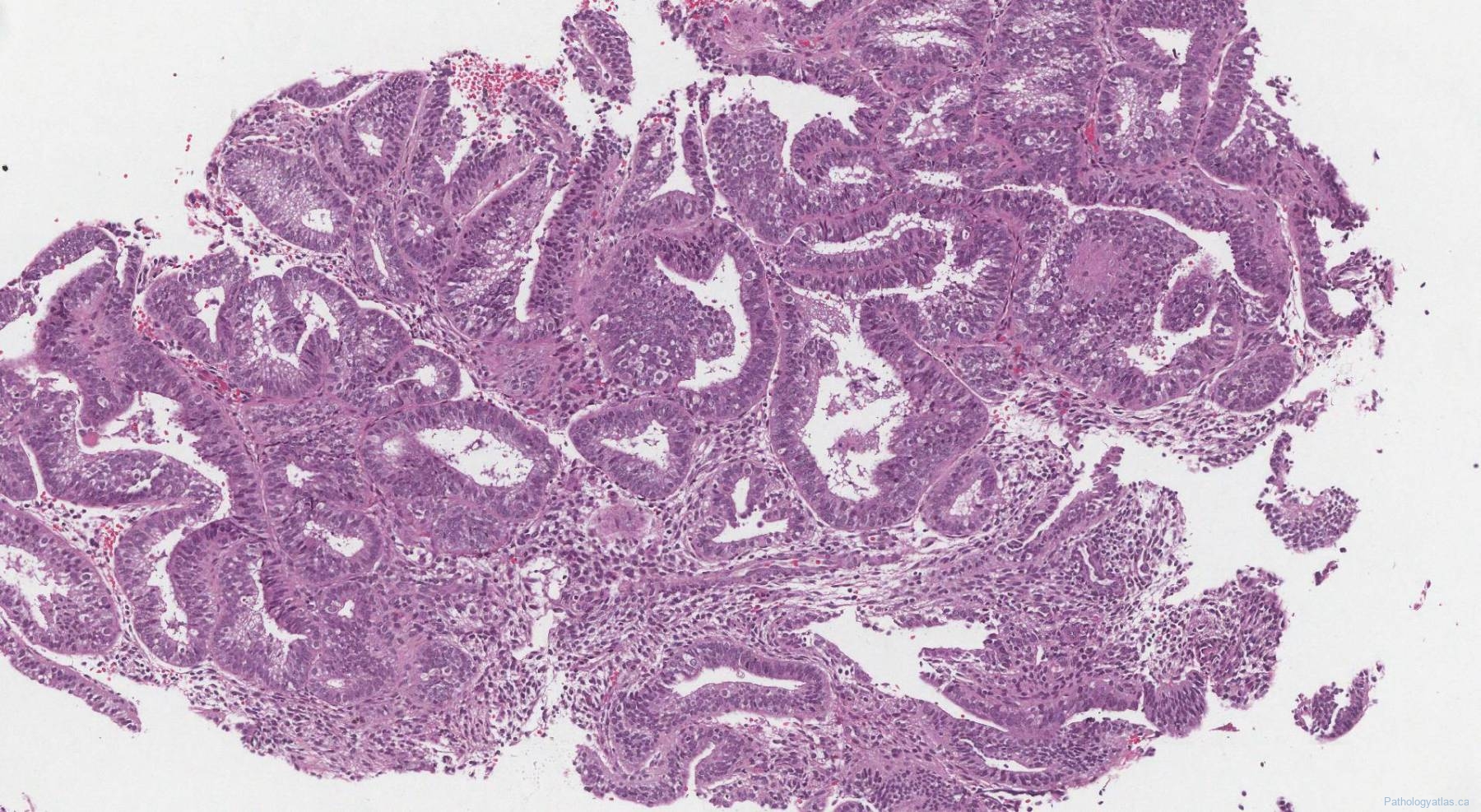 endometrial hyperplasia with atypia Archives | Atlas of Pathology