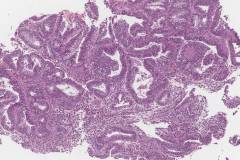 Endometrial hyperplasia with atypia