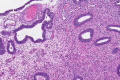 Endometrial serous intraepithelial carcinoma