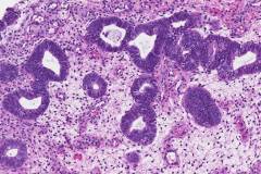 Endometrial serous intraepithelial carcinoma