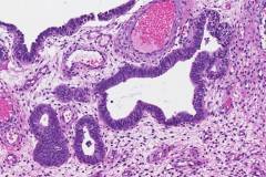 Endometrial serous intraepithelial carcinoma