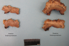 Endometrioid carcinoma of the endometrium