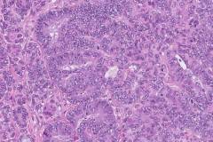 Endometrioid carcinoma of the ovary