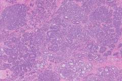 Endometrioid carcinoma of the ovary