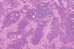 Endometrioid carcinoma of the ovary