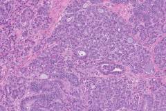 Endometrioid carcinoma of the ovary