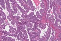 Endometrioid carcinoma of the ovary