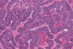 Endometrioid carcinoma of the ovary