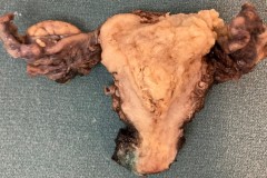 Endometrial endometrioid carcinoma