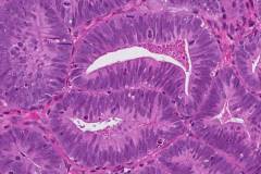 Endometrioid carcinoma of the uterus