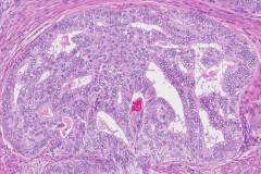 Endometrioid carcinoma of the uterus