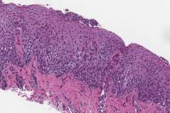 Eosinophilic esophagitis