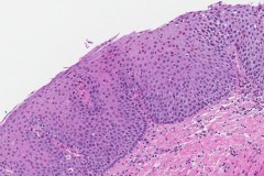 Eosinophilic esophagitis