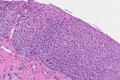 Eosinophilic esophagitis