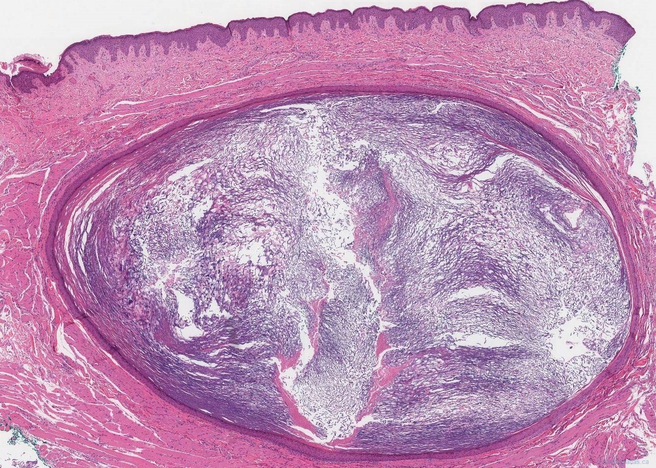 Epidermoid Cyst Atlas Of Pathology 5883