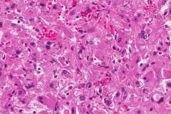 Epithelioid angiomyolipoma of the kidney