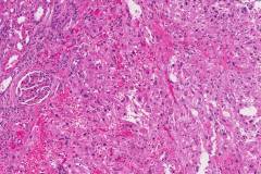 Epithelioid angiomyolipoma of the kidney