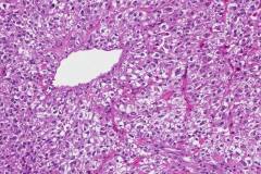 Epithelioid angiomyolipoma arising in the retroperitoneum