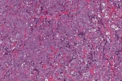 Epithelioid angiosarcoma of the breast