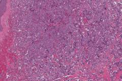 Epithelioid angiosarcoma of the breast